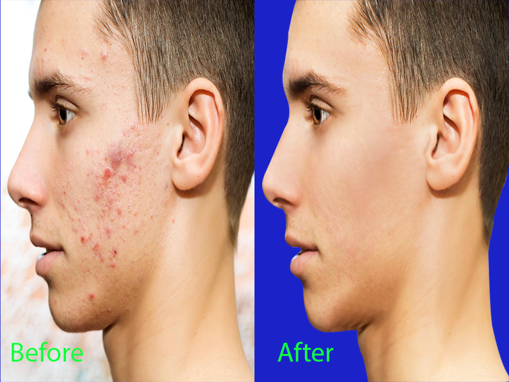 I will professional portrait retouching acne removal ...